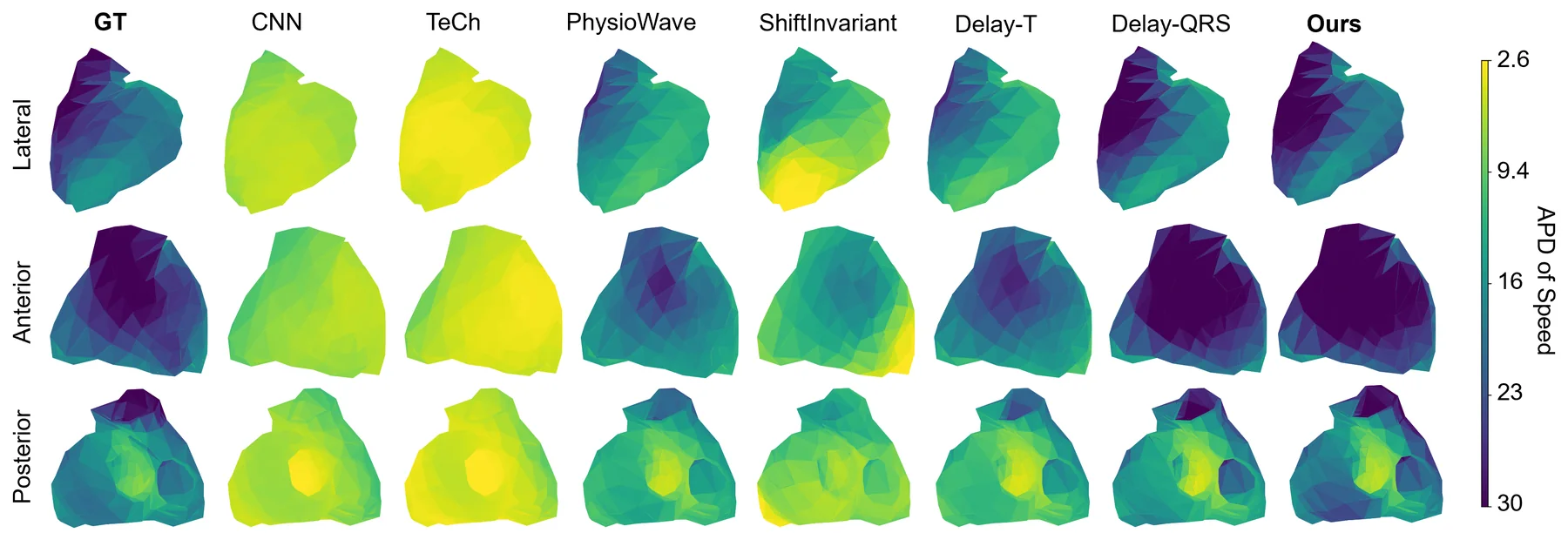 Heart meshes from lateral, anterior and posterior views colored by the average pairwise distance of vertex speed. Ground truth and Time2Track show dark, heterogeneous patterns, while CNN and TeCh are uniformly yellow.